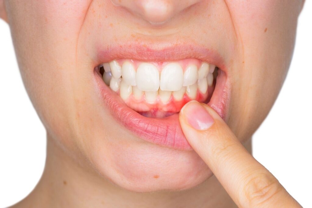 Gum Disease Treatments in Ealing